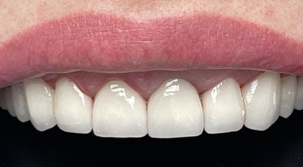 Po leczeniu: Metamorfoza w „Hollywood smile”