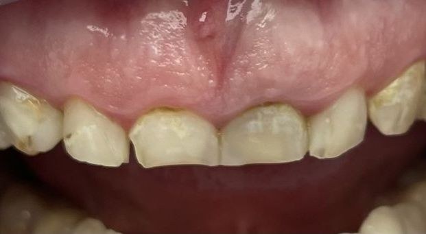 Przed leczeniem: Metamorfoza w „Hollywood smile”