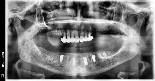 Proteza na czterech implantach, zdjęcie 1