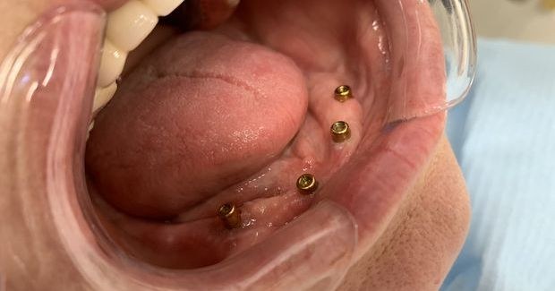 Proteza na czterech implantach, zdjęcie 2