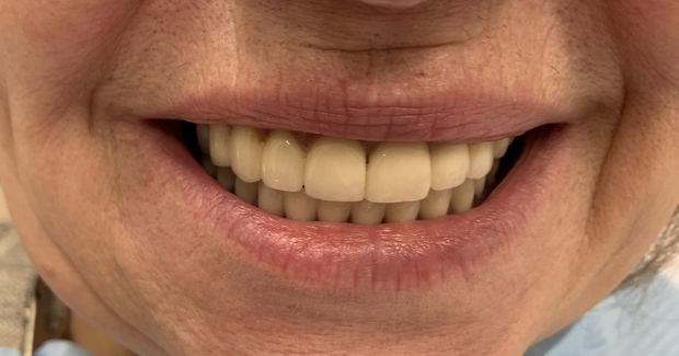 Proteza na czterech implantach, zdjęcie 4